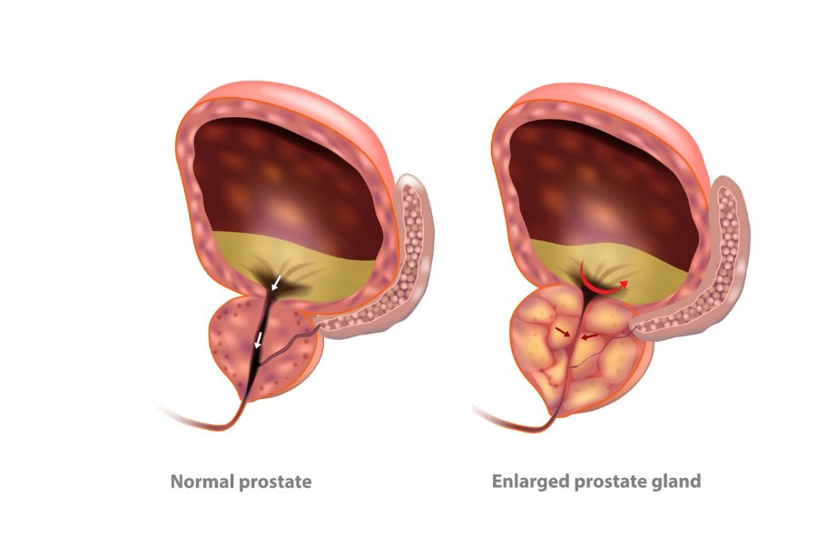 Holmium laser enucleation of the prostate HoLEP